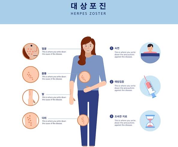 대상포진 초기증상 체크리스트! 절대 놓치지 말아야 할 신호